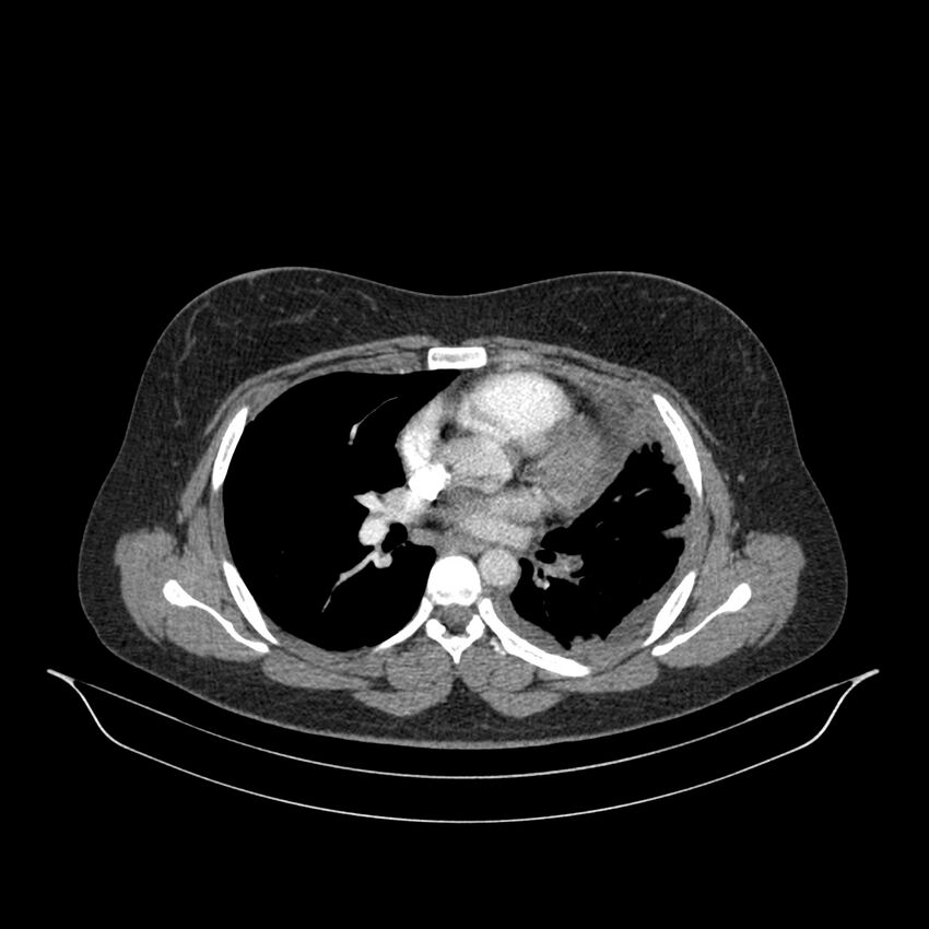Chronic thromboembolic pulmonary hypertension (CTEPH) (Radiopaedia 74597-85532 Axial C+ CTPA 85).jpg