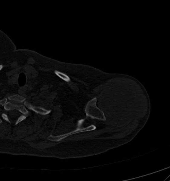 File:Clear cell chondrosarcoma - humerus (Radiopaedia 63104-71612 Axial bone window 24).jpg