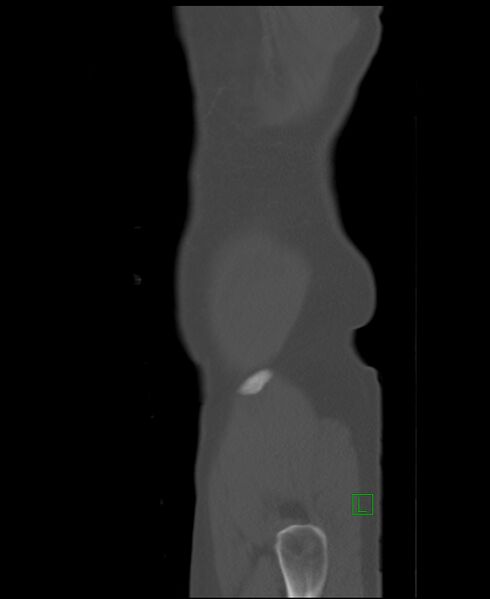 File:Clear cell renal cell carcinoma (Radiopaedia 85006-100539 Sagittal bone window 1).jpg