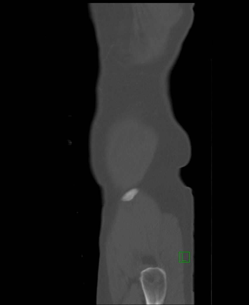 Clear cell renal cell carcinoma (Radiopaedia 85006-100539 Sagittal bone window 1).jpg
