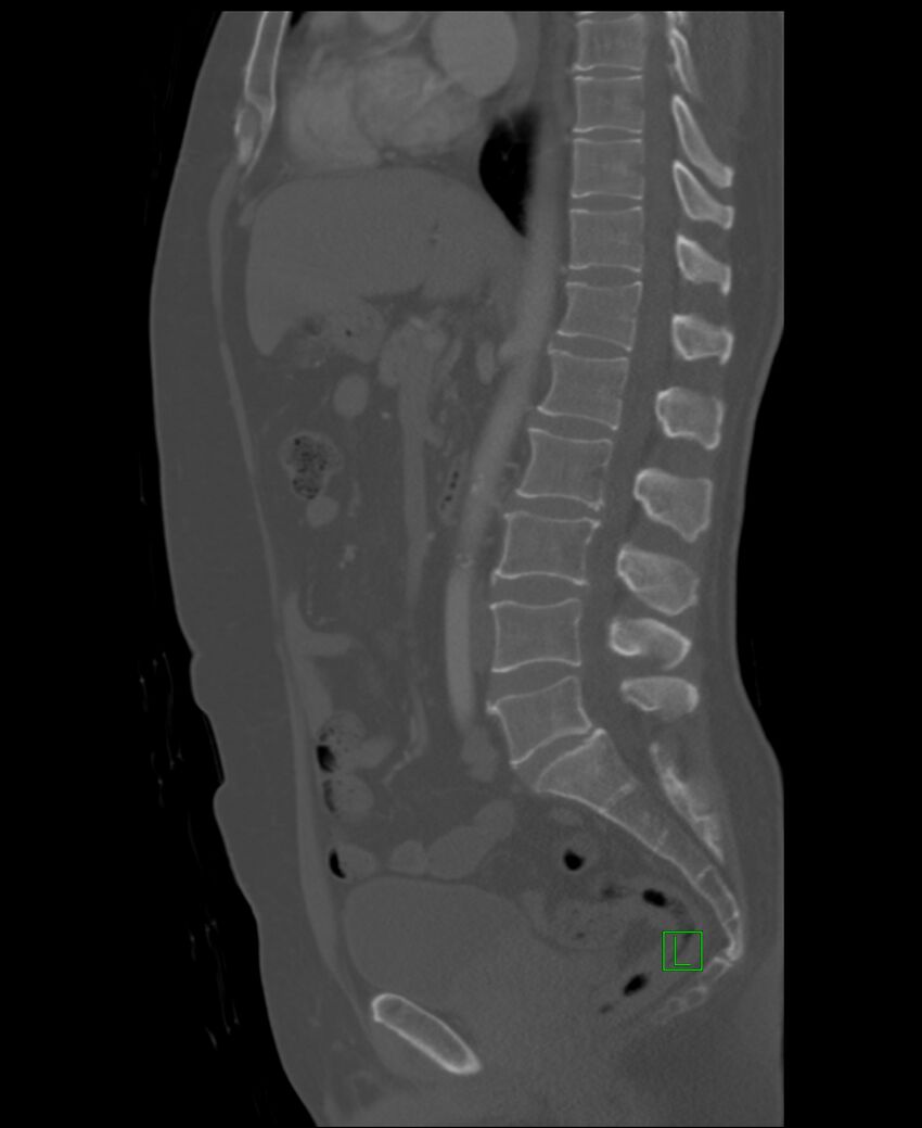 Clear cell renal cell carcinoma (Radiopaedia 85006-100539 Sagittal bone window 31).jpg