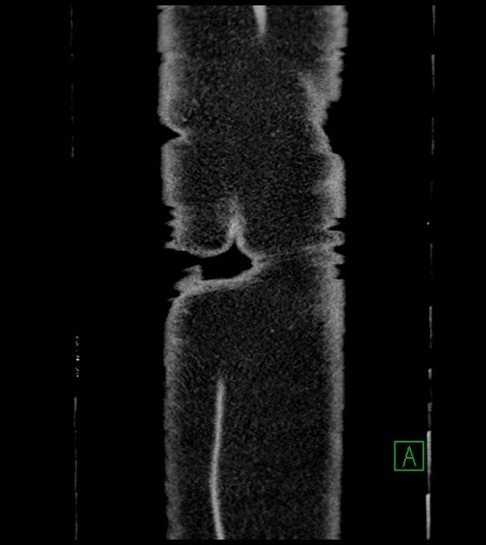 File:Closed-loop small bowel obstruction-internal hernia (Radiopaedia 78439-91096 Coronal non-contrast 106).jpg