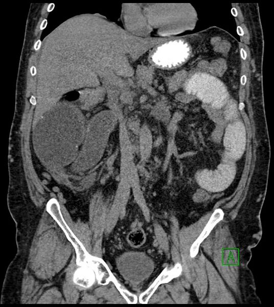 File:Closed-loop small bowel obstruction-internal hernia (Radiopaedia 78439-91096 Coronal non-contrast 52).jpg