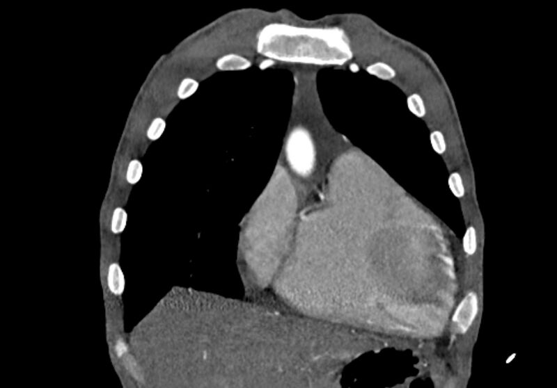 File:Coarctation of aorta with aortic valve stenosis (Radiopaedia 70463-80574 C 35).jpg