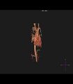 Coarctation of the aorta (Radiopaedia 43373-46729 3D reconstruction 28).jpg