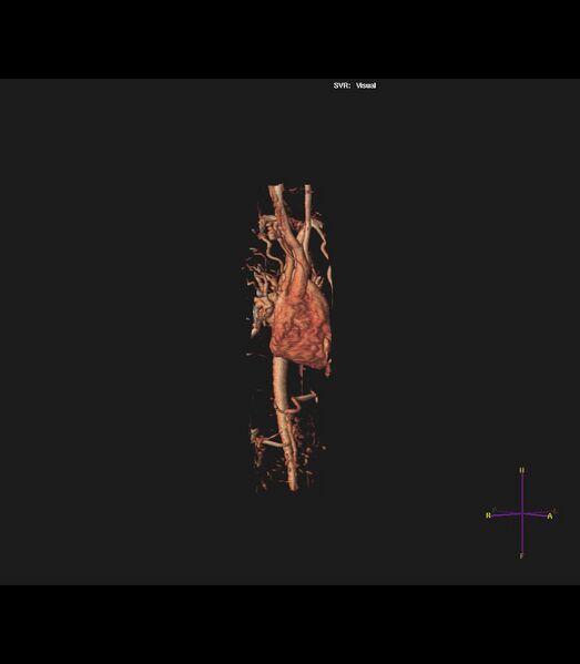 File:Coarctation of the aorta (Radiopaedia 43373-46729 3D reconstruction 28).jpg