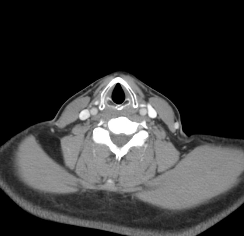 Colloid cyst of thyroid (Radiopaedia 22897-22923 Axial C+ delayed 51).jpg