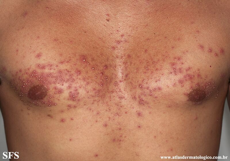 File:Folliculitis (Dermatology Atlas 21).jpg