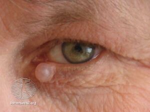 More images of hidrocystoma of the eyelid. (DermNet NZ hidrocystoma-02).jpg