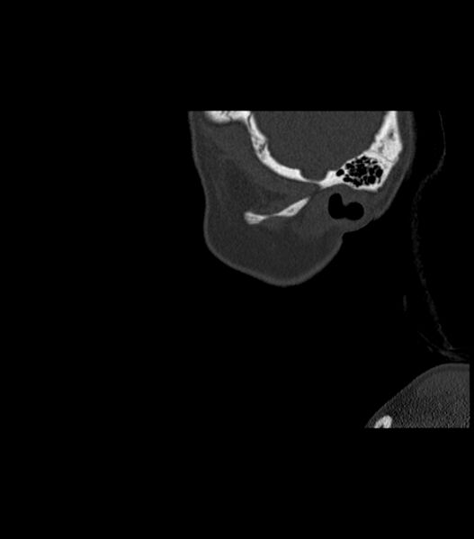 File:Nasoorbitoethmoid fracture (Radiopaedia 90044-107205 Sagittal bone window 130).jpg
