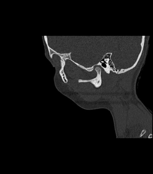 File:Nasoorbitoethmoid fracture (Radiopaedia 90044-107205 Sagittal bone window 33).jpg