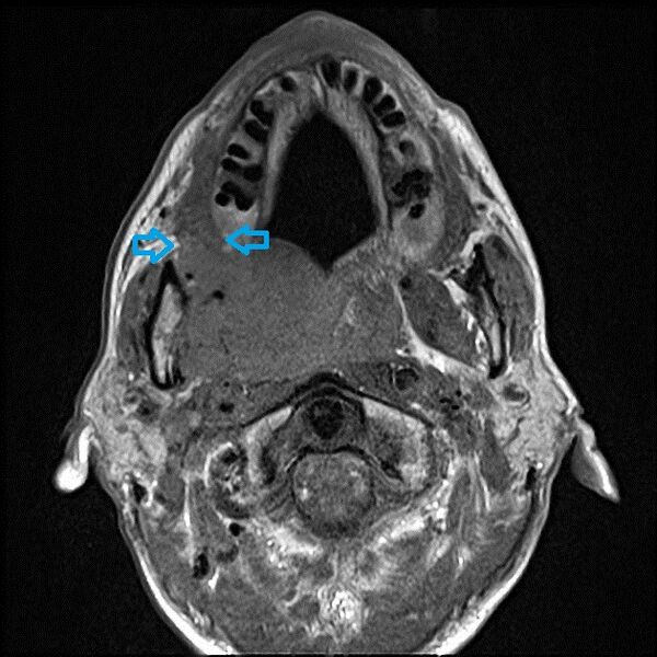 File:Nasopharyngeal carcinoma with skull base invasion (Radiopaedia 59258-66624 E 1).jpeg
