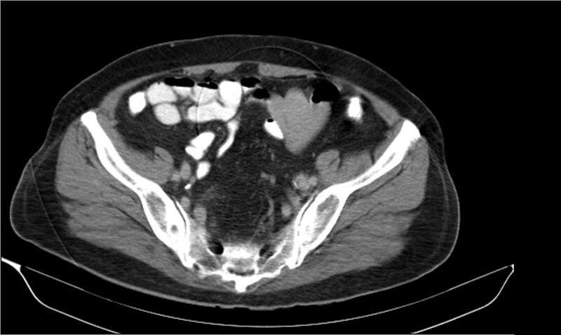 File:Necrotizing pancreatitis (Radiopaedia 20595-20495 Axial C+ delayed 37).jpg