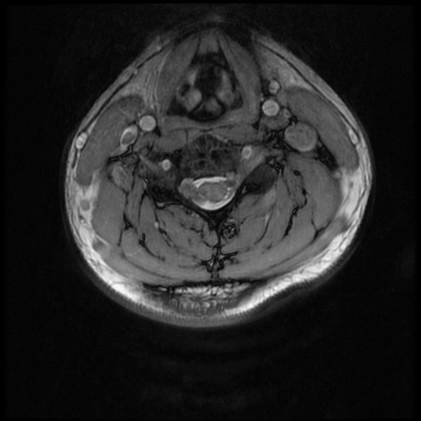 File:Neurofibromatosis type 2 (Radiopaedia 44936-48837 Axial Gradient Echo 21).png