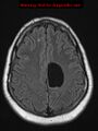 Neuroglial cyst (Radiopaedia 10713-11184 Axial FLAIR 6).jpg
