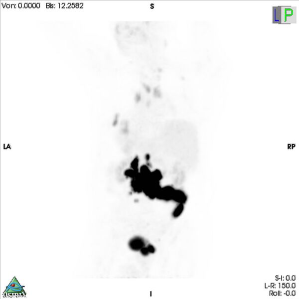 File:Non-Hodgkin lymphoma involving seminal vesicles with development of interstitial pneumonitis during Rituximab therapy (Radiopaedia 32703-33675 PET cor 3D MIP 6).jpg