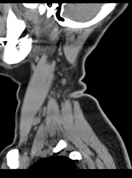 File:Normal cervical spine MRI (including Dixon) (Radiopaedia 42762-45926 C 4).png