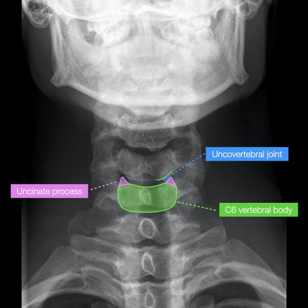 File:Normal cervical spine radiographs (Radiopaedia 32505-96697 B 5).jpeg