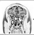 Normal coronal brain (Radiopaedia 6676-7910 B 6).jpg