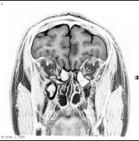 File:Normal coronal brain (Radiopaedia 6676-7910 B 6).jpg