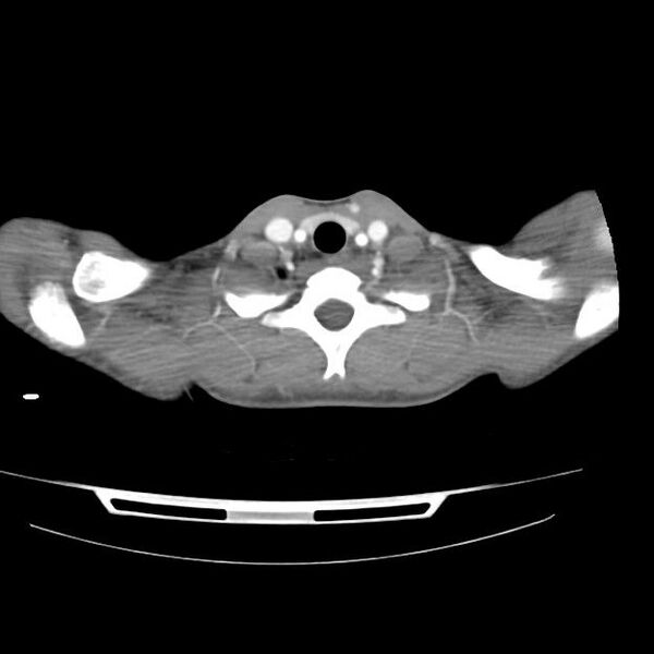 File:Normal dual-phase trauma CT chest,abdomen and pelvis (Radiopaedia 48092-52899 A 3).jpg