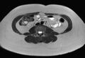 Normal liver MRI with Gadolinium (Radiopaedia 58913-66163 Axial T2 1).jpg