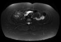 Normal liver MRI with Gadolinium (Radiopaedia 58913-66163 Axial T2 fat sat 6).jpg