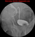Normal retrograde pyelography of a native and transplant kidney (Radiopaedia 40480-43054 Transplant kidney 27).jpg