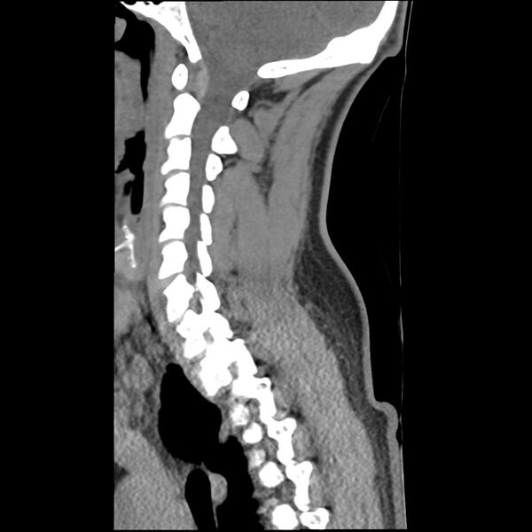 File:Normal trauma spine imaging (Radiopaedia 31753-32686 A 15).jpg