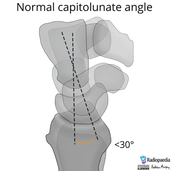File:Normal wrist alignment, dorsal and volar intercalated segmental instability (illustration) (Radiopaedia 80949-94486 A 3).png