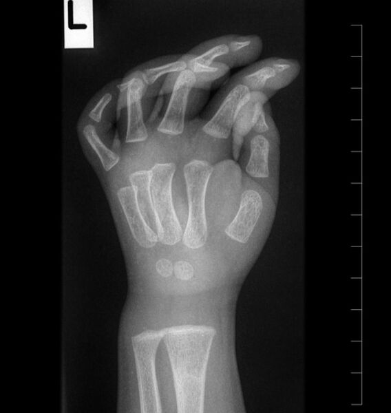 File:Normal wrist and hand x-ray (2-year-old) (Radiopaedia 53073-59034 A 1).jpg