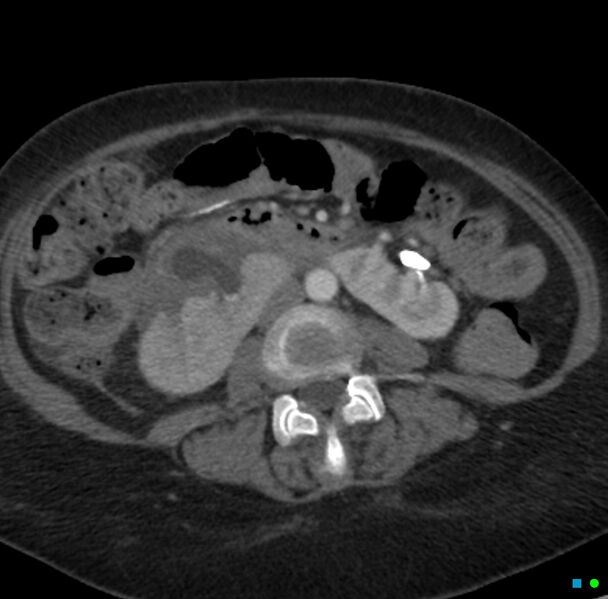 File:Obstructed infected horseshoe kidney (Radiopaedia 18116-17898 B 16).jpg