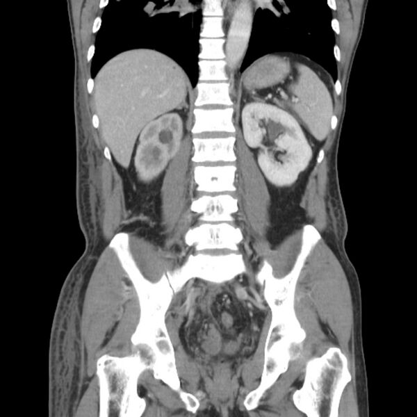 File:Obstructive bladder transitional cell carcinoma (Radiopaedia 9825-10410 B 18).jpg