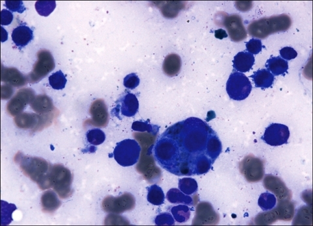 Bone marrow aspirate from the individual with Plasmodium vivax infection