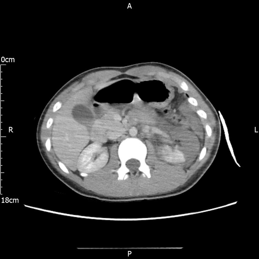 AAST grade IV kidney injury with CEUS follow-up (Radiopaedia 72353-82877 Axial C+ portal venous phase 25).jpg