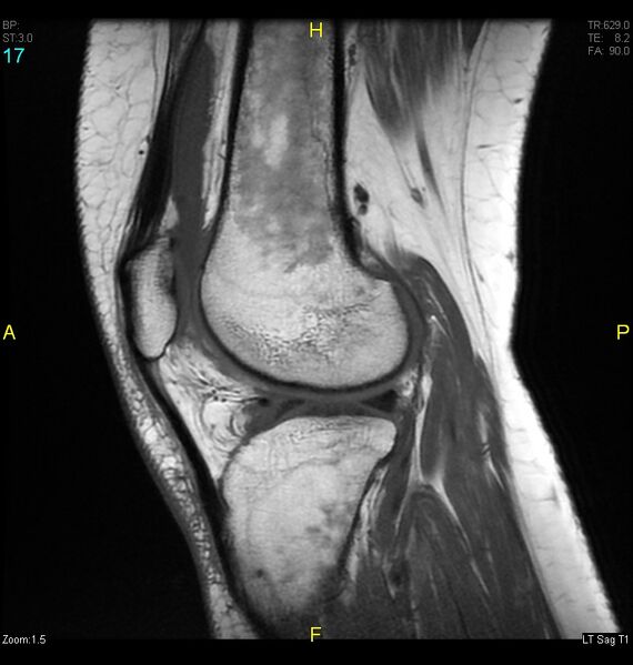 File:ACL mucoid degeration with cystic changes (Radiopaedia 48428-53341 Sagittal T1 15).jpg