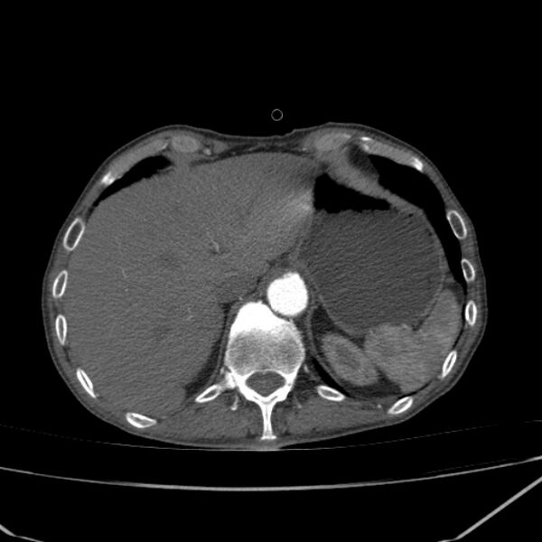 File:Abdominal aortic aneurysm (Radiopaedia 23703-23856 Axial C+ arterial phase 8).jpg