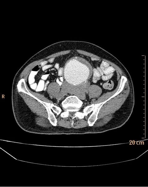File:Abdominal aortic aneurysm (Radiopaedia 25985-26121 Axial C+ arterial phase 28).jpg