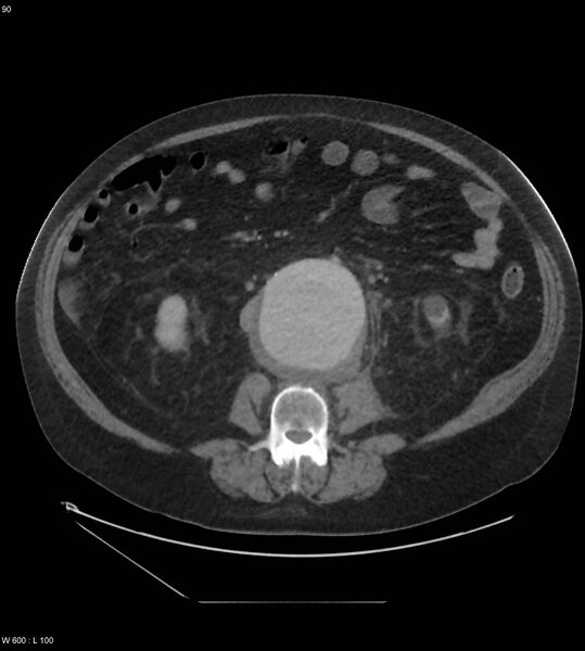File:Abdominal aortic aneurysm with intramural hematoma then rupture (Radiopaedia 50278-55631 Axial C+ arterial phase 81).jpg