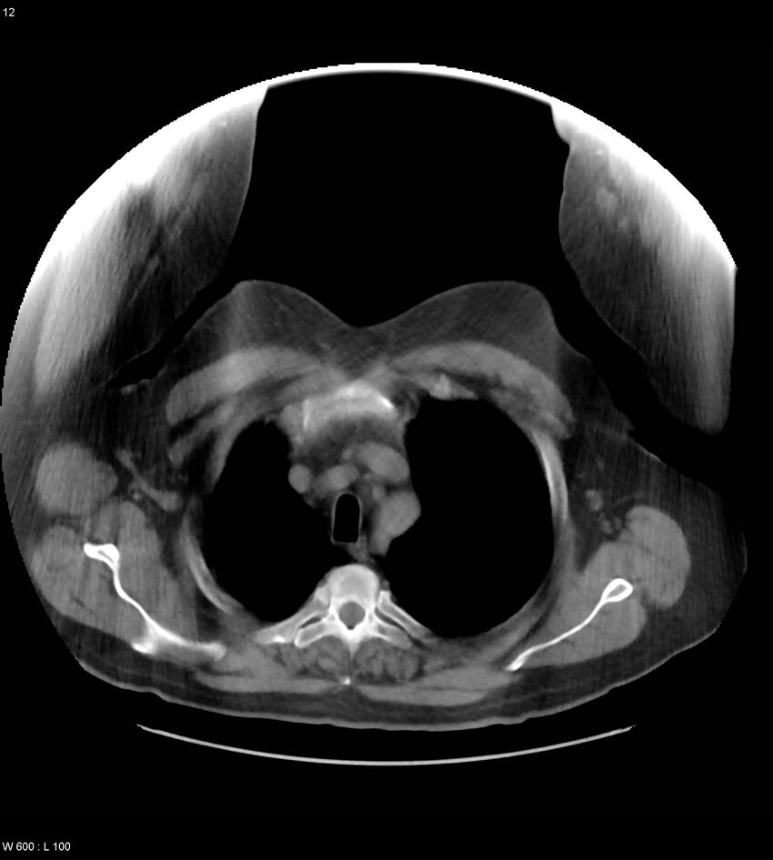 Abdominal aortic aneurysm with intramural hematoma then rupture (Radiopaedia 50278-55631 Axial non-contrast 8).jpg
