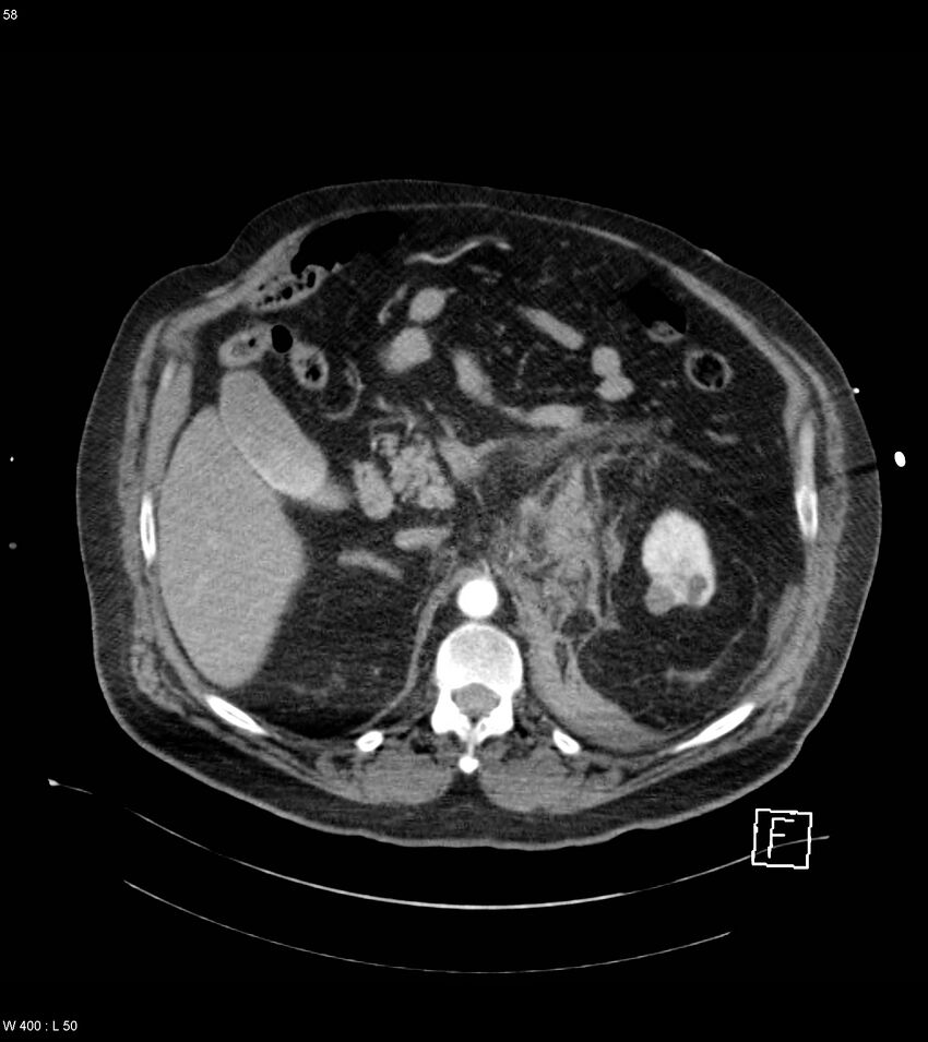Abdominal aortic aneurysm with intramural hematoma then rupture (Radiopaedia 50278-55632 Axial C+ arterial phase 57).jpg