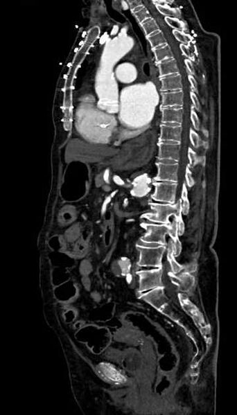 File:Abdominal aortic aneurysm with thrombus fissuration (Radiopaedia 73192-83919 Sagittal C+ arterial phase 64).jpg
