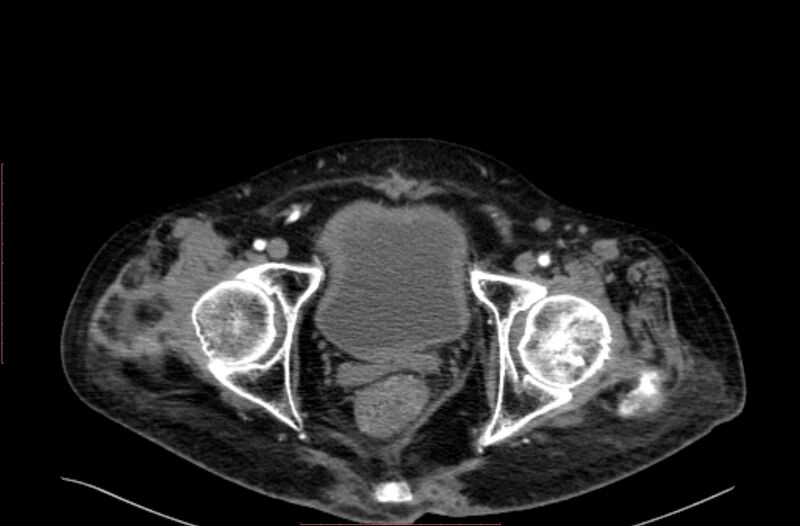 File:Abdominal aortic interposition tube graft and aneurysm thrombosis (Radiopaedia 71438-81857 Axial C+ arterial phase 229).jpg