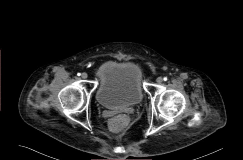 Abdominal aortic interposition tube graft and aneurysm thrombosis (Radiopaedia 71438-81857 Axial C+ arterial phase 229).jpg