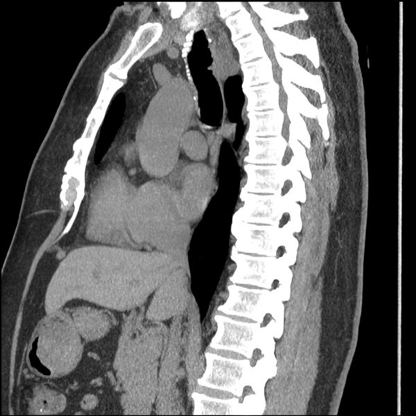 File:Aberrant right subclavian artery (Radiopaedia 40967-43680 Sagittal non-contrast 49).jpg