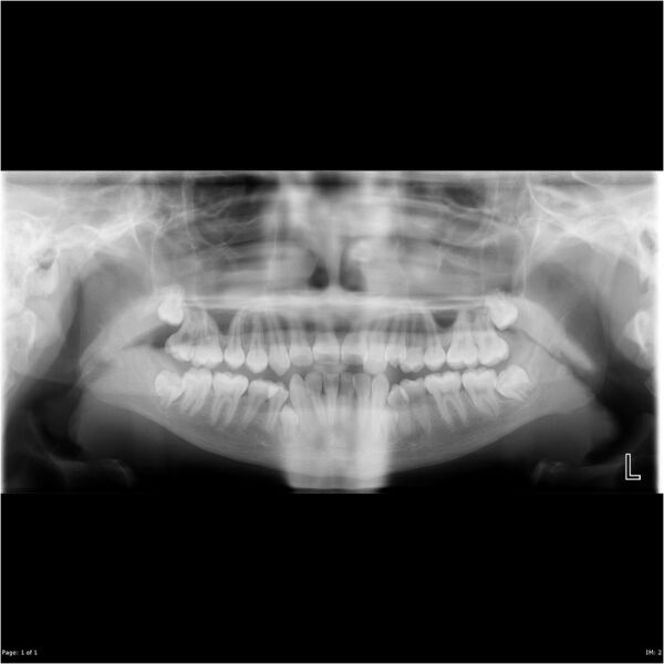 File:Accessory premolar teeth (Radiopaedia 22225).jpg
