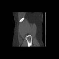 Acetabular fracture (Radiopaedia 13193-13212 Sagittal bone window 6).jpg