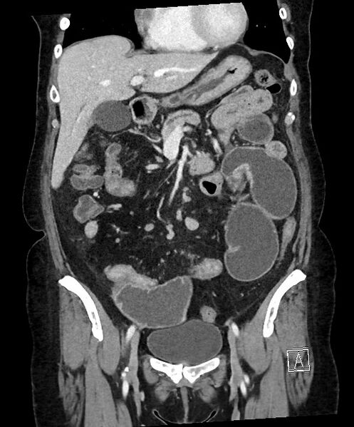 File:Active Crohn disease (Radiopaedia 59394-66750 Coronal C+ portal venous phase 31).jpg