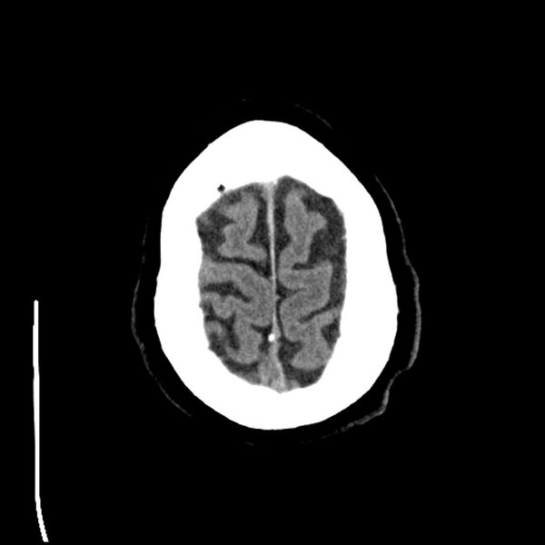 File:Acute A3 occlusion with ACA ischemic penumbra (CT perfusion) (Radiopaedia 72036-82525 Axial non-contrast 42).jpg