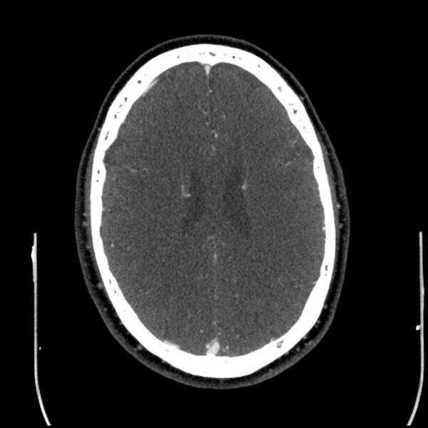 File:Acute A3 occlusion with ACA ischemic penumbra (CT perfusion) (Radiopaedia 72036-82527 Axial C+ arterial phase thins 30).jpg